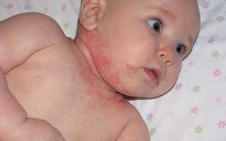 Аллергия на глютен у ребенка